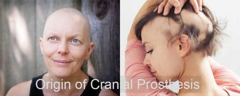 Basic Guide Of Cranial Prosthesis Aka Medical Wigs