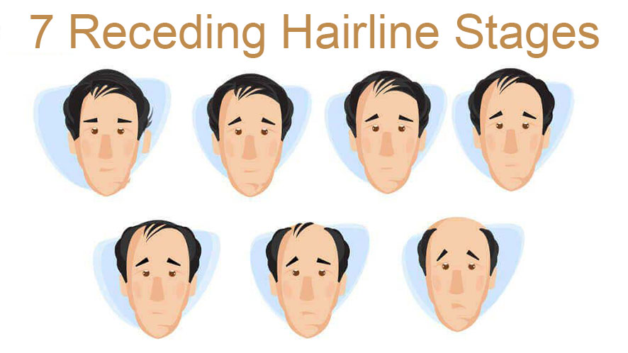 Save Your Receding Hairline Guide: How To Stop Receding Hairline?