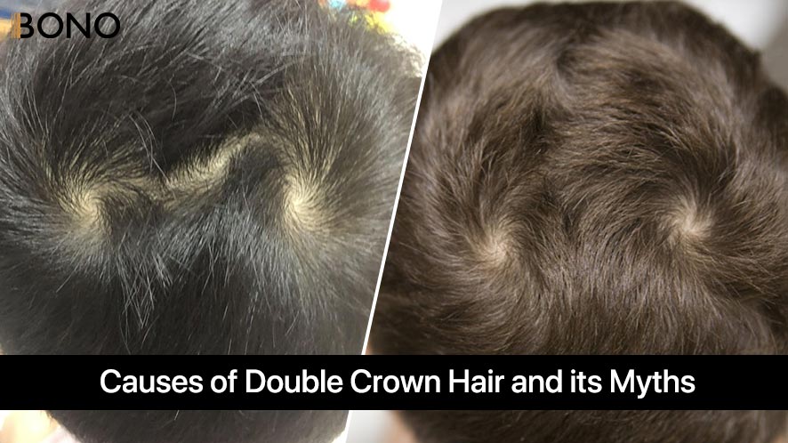 Causes Of Double Crown Hair And Its Myths 3 