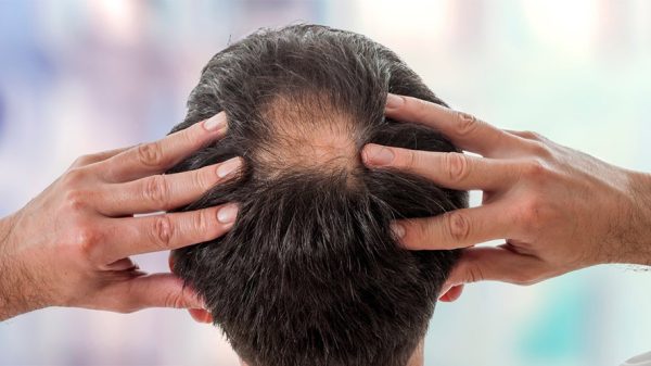 Cowlick vs. Balding: Similar Yet Different Hair Problems