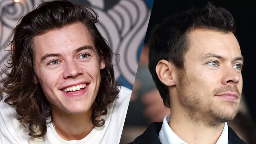 Is Harry Styles Bald?