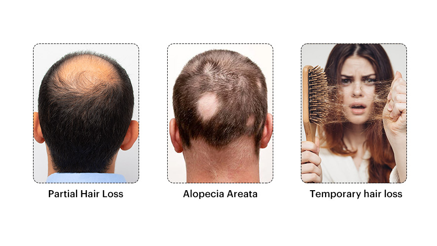 Suitable Hair Loss Patterns for a Clip-On Hair System