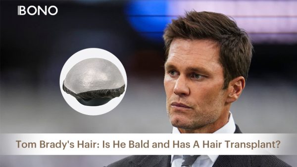 Tom Brady's Hair: Is He Bald and Has A Hair Transplant